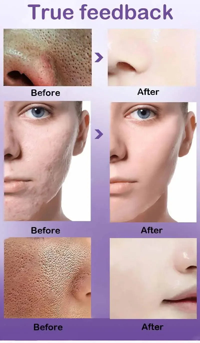 Skin Texture Pore Refining Resurfacing Brightening Facial Serum Retinol and Niacinamide Non-Comedogenic