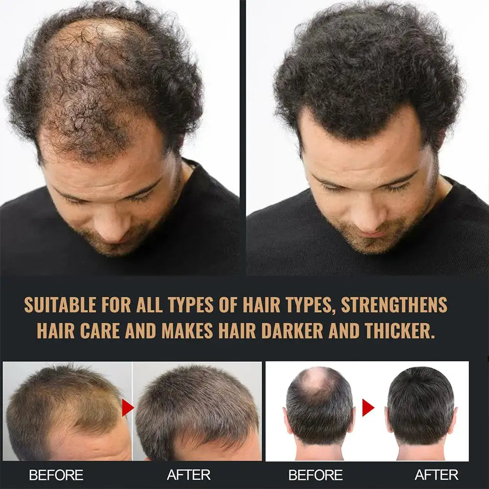 Anti Baldness Shampoo Thickening Root Activator Nourish Regrowth for Thinning Hair & Hair Loss
