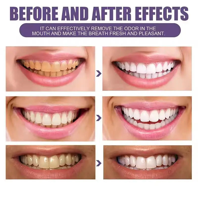 Purple Whitening Teeth Stickers 14 Pairs