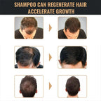 Anti Baldness Shampoo Thickening Root Activator Nourish Regrowth for Thinning Hair & Hair Loss