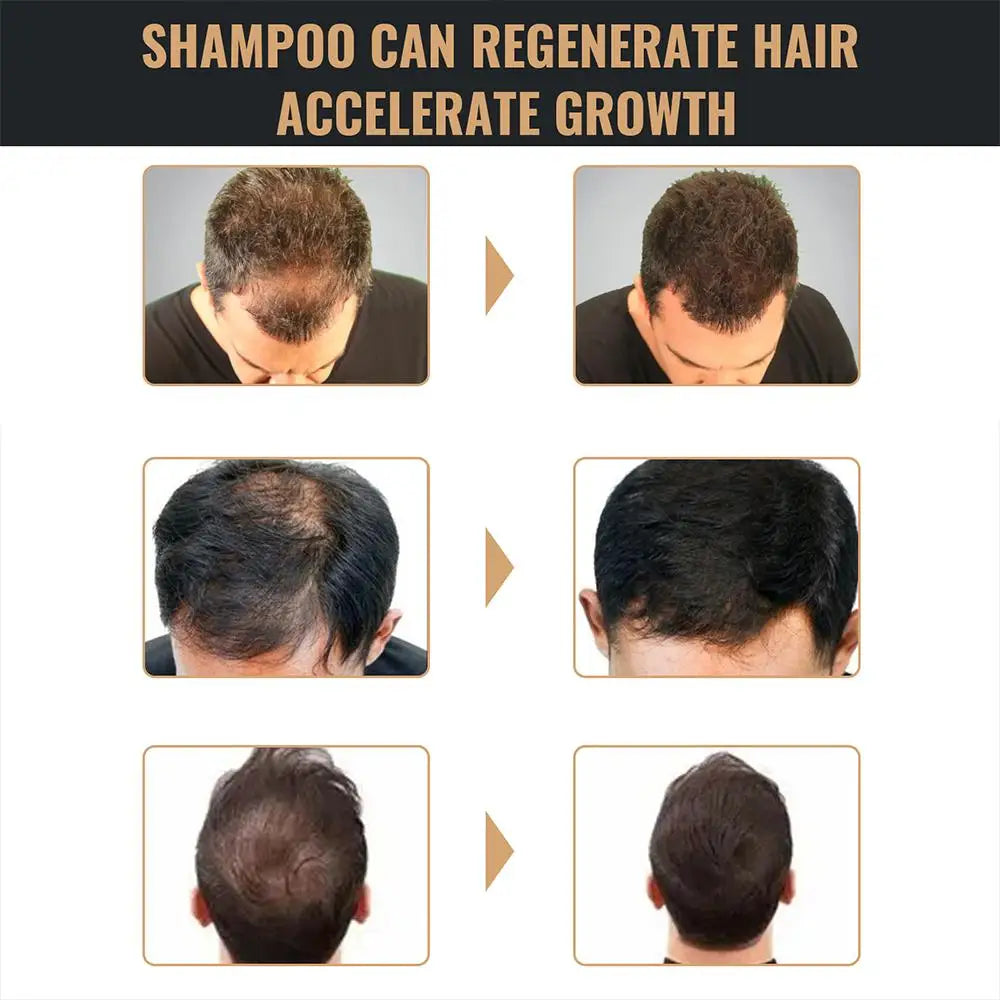 Anti Baldness Shampoo Thickening Root Activator Nourish Regrowth for Thinning Hair & Hair Loss