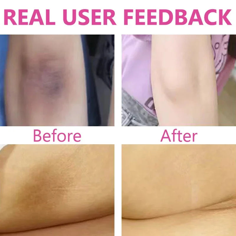 Brightening Cream For Body Knees Remove Dull Pigments Elbows Knuckles Lightening